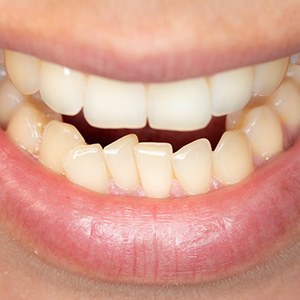 Closeup of a smile with overcrowded lower teeth