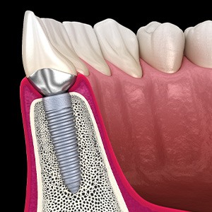 A model of a dental implant in the jawbone