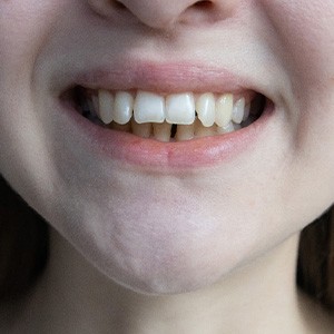 Nose-to-neck view of woman with overbite smiling