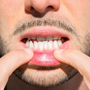 Man pulling down lower lip to reveal his underbite