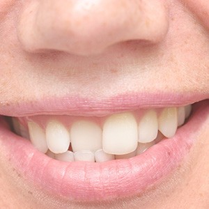 Closeup of a smile with one front tooth resting inside lower arch