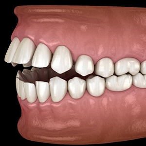 Rendering profile view of open bite with black background