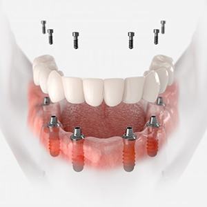 a 3D depiction of an implant denture