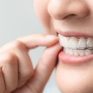 Closeup of patient wearing clear aligners